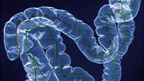 Colorectal cancer: Symptoms and what causes it | FOX 9 Minneapolis-St. Paul