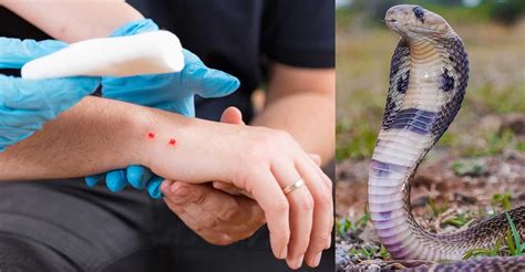 Call 108 in snakebite cases; no need to search for hospitals with ...