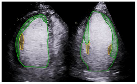 Novel, Contrast Echocardiography-Based Trabeculation Quantification Method in the Diagnosis of ...