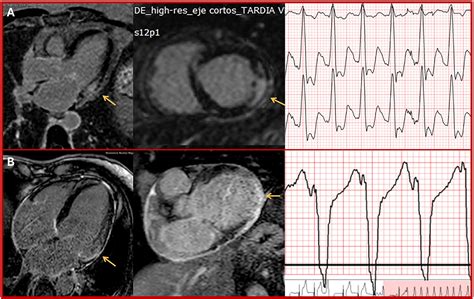 Mechanisms behind the high mortality rate in chronic Chagas cardiomyopathy: Unmasking a three ...