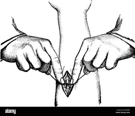 Wire procedure Black and White Stock Photos & Images - Alamy