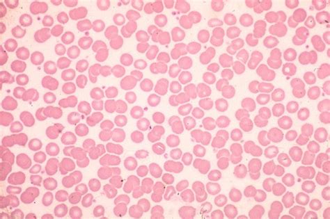 Blood Lab Exam Flashcards | Quizlet