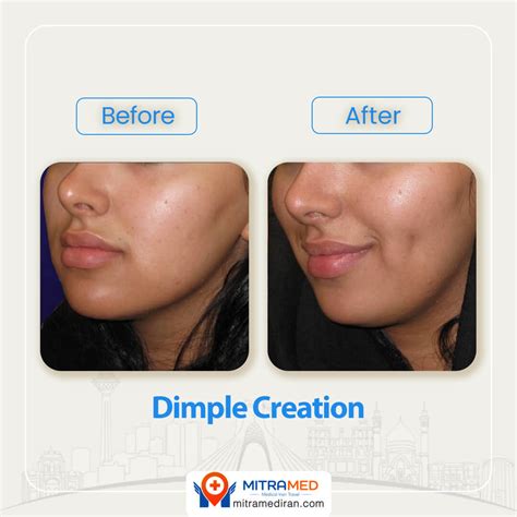 Dimple Surgery in Iran | Dimpleplasty | Dimple Creation | MITRAMED