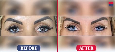 Image result for Eye Color Surgery