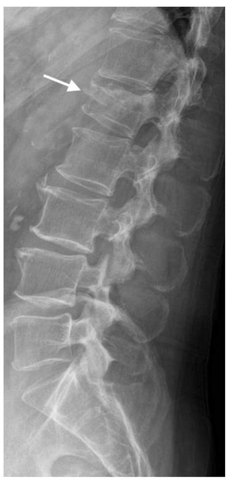 Radiological Diagnosis and Advances in Imaging of Vertebral Compression ...