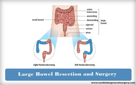 Image result for Open Colon Resection Surgery