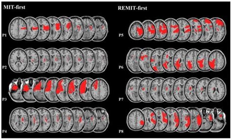 Reversed Mirror Therapy (REMIT) after Stroke—A Proof-of-Concept Study