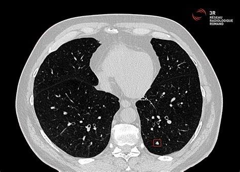 Image result for Poumon Normal Scanner