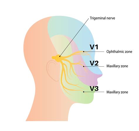 Atypical Trigeminal Neuralgia