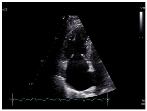 The Role of Echocardiography in the Diagnosis of Cardiac Involvement in ...