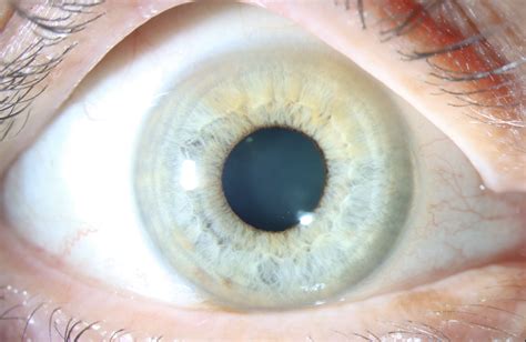 Atlas Entry - Primary acquired melanosis (PAM)