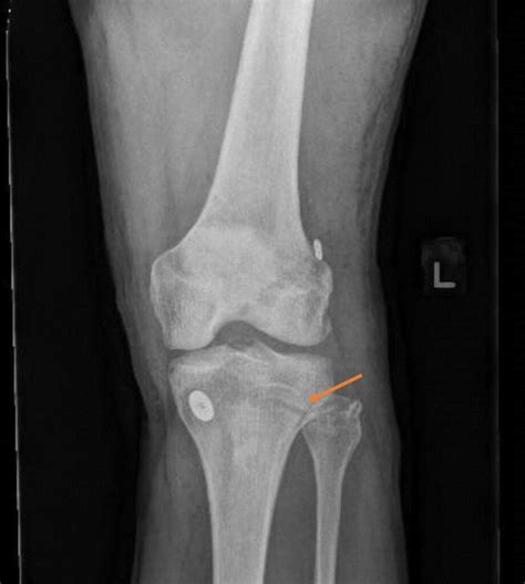 Proximal Tibiofibular Joint Proximal Tibiofibular Joint Injury