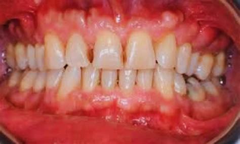 Buccal Maxillary Exostoses may Contribute to Excessive Gingival Display ...