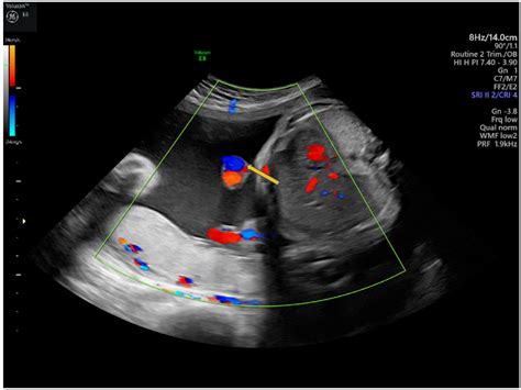 Clinically Relevant Prenatal Ultrasound Diagnosis of Umbilical Cord ...