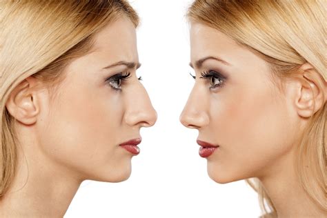 13 Tips to Speed Up Your Rhinoplasty Recovery Time | Dr. Farrior