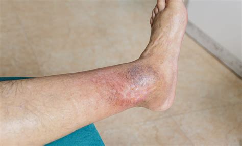 Chronic Venous Stasis Ulcers