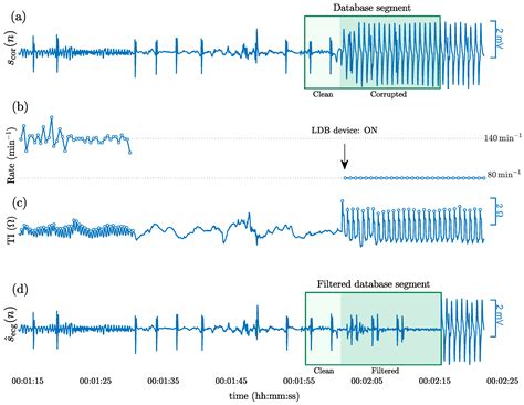 Artificial Intelligence for Multiclass Rhythm Analysis for Out-of ...