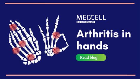 Arthritis In Hands | Bone Health By Medcell Pharma