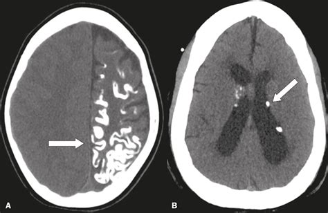 Cmv Periventricular Calcification