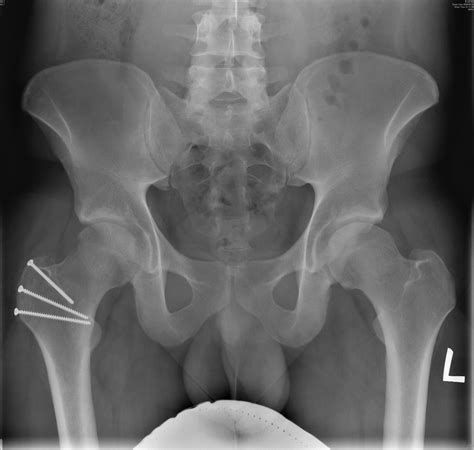 Open Surgical Dislocation Hip | Orthowood
