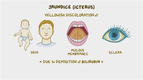 Newborn Jaundice Causes Symptoms Treatment Newborn Jaundice
