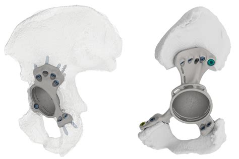 High accuracy of positioning custom triflange acetabular components in tumour and total hip ...