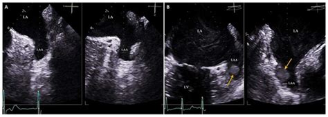 Multimodality Imaging in the Study of the Left Atrium
