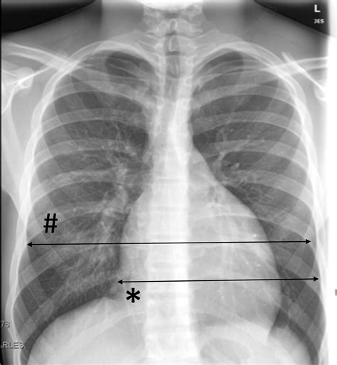 Abnormal Chest X Ray