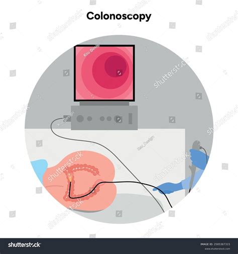 Image result for Colonoscopy Looping