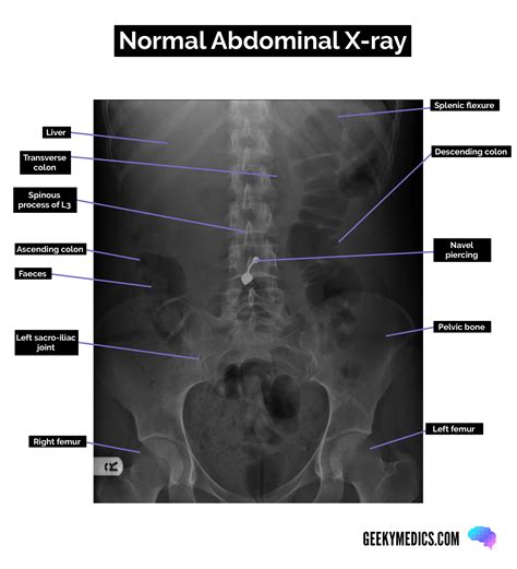 Abdominal X-ray Interpretation (AXR) | Radiology | OSCE | Geeky Medics