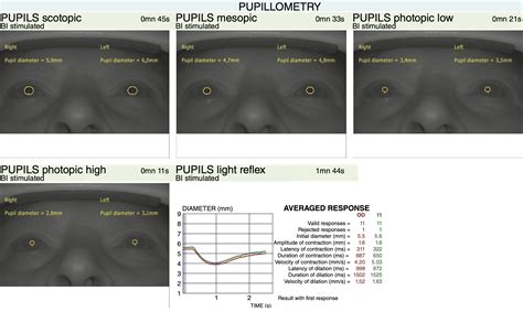 Pupillary Function Altered in Early-Stage Glaucoma