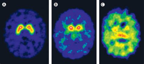 Image result for Normal DaTscan