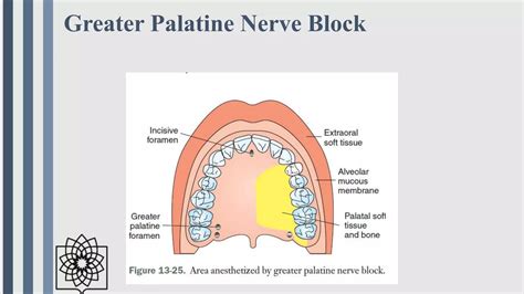 Techniques of local anesthesia in dentistry IN A NUTSHELL | PPTX