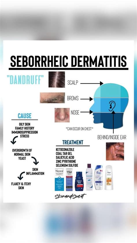 Best 13 Seborrheic Dermatitis Vs Psoriasis: How to Identify and Treat ...