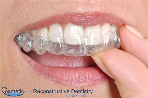 How to Fix an Underbite | Invisalign Can Help! | Midtown, NY