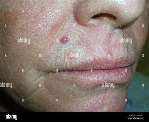 Basal cell carcinoma Stock Photo - Alamy