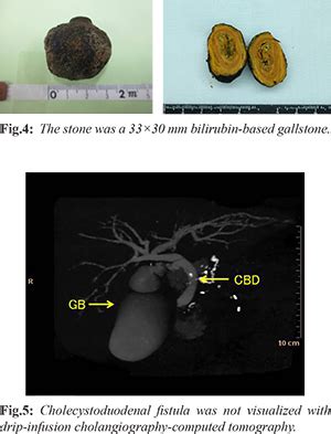 Arterial Bleeding caused by a Dropped Gallstone from a ...