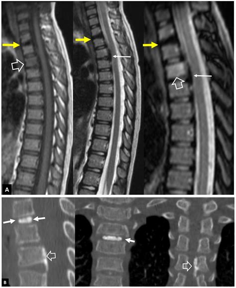 Musculoskeletal Infection: The Great Mimickers on Imaging