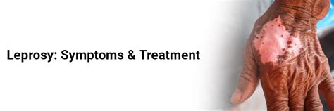 Leprosy: Symptoms & Treatment