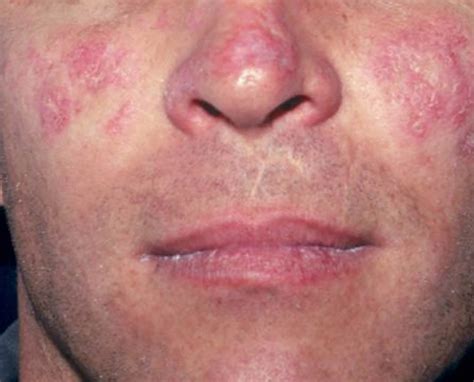 Lupus - Systemic Lupus Erythematosus (SLE) - Causes, Sign & Symptoms