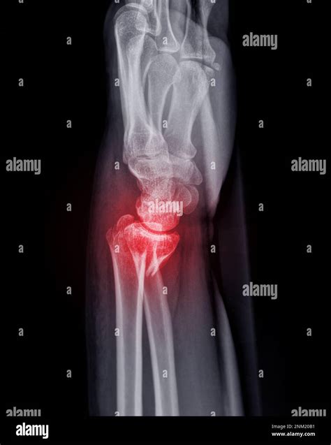 Normal Wrist X Ray Lateral