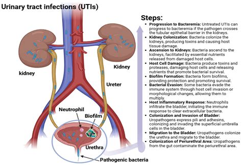 Urinary Tract Infection Complicated Signs And Symptoms Urinary Tract