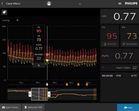 iFR Coronary Physiology - Philips
