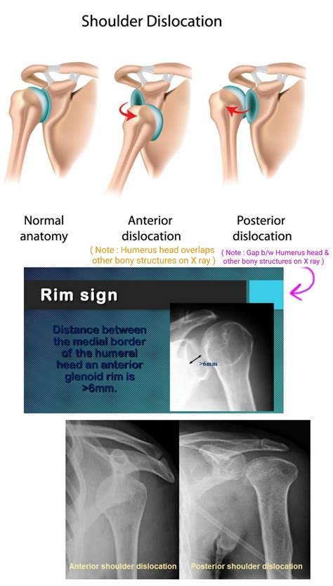 Anterior Vs Posterior Hip Dislocation Presentation