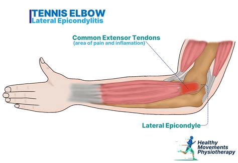 Dry Needling and Tennis Elbow: Does It Really Work - Healthy Movements Physiotherapy