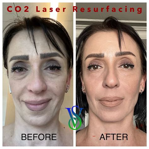CO2 Laser Under Eyes Resurfacing: Correcting Bags & Circles
