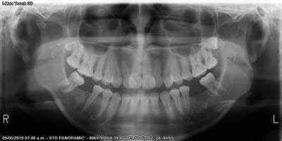 Teeth Segmentation on Dental X-ray Images - Dataset Ninja
