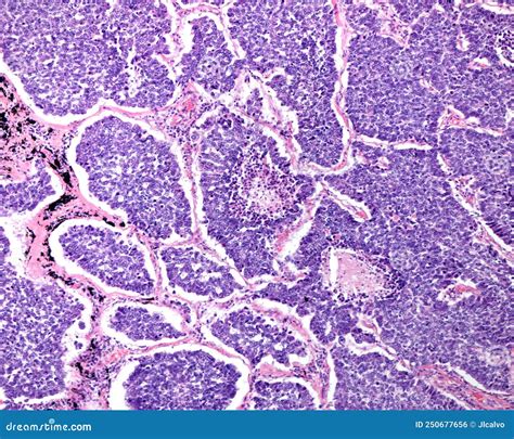 Human Lung. Small Cell Carcinoma Stock Photo - Image of cancer, oncology: 250677656