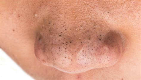 Exfoliante natural para acabar con los puntos negros, cultora de ...