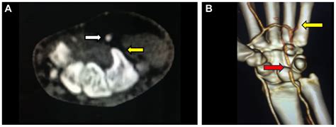 Successful percutaneous management of hypothenar hammer syndrome with thrombosuction and ...